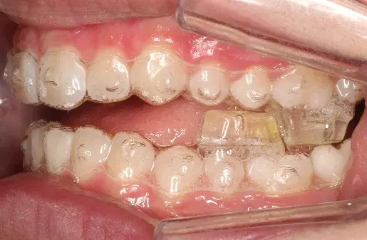 Teeth With Occlusal Blocks
