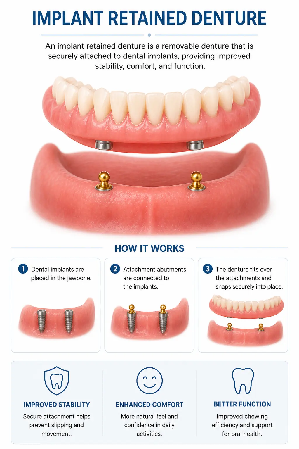 Implant Supported Overdenture Infogram Portrait